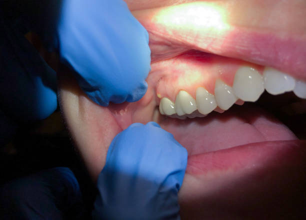 Best Emergency Wisdom Teeth Removal in Murillo, TX